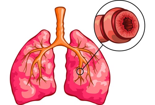 Tìm hiểu về bệnh viêm phế quản co thắt và giải pháp cải thiện bệnh từ thảo dược